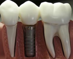 Вид имплантированного зуба