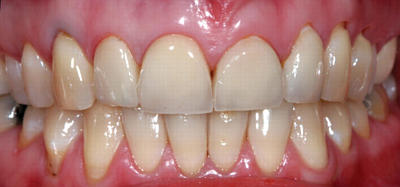 Протезирование зубов металлическими коронками